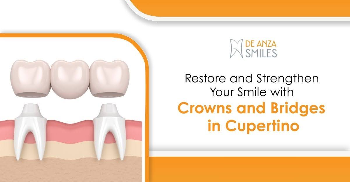 Restore and Strengthen Your Smile with Crowns and Bridges in Cupertino