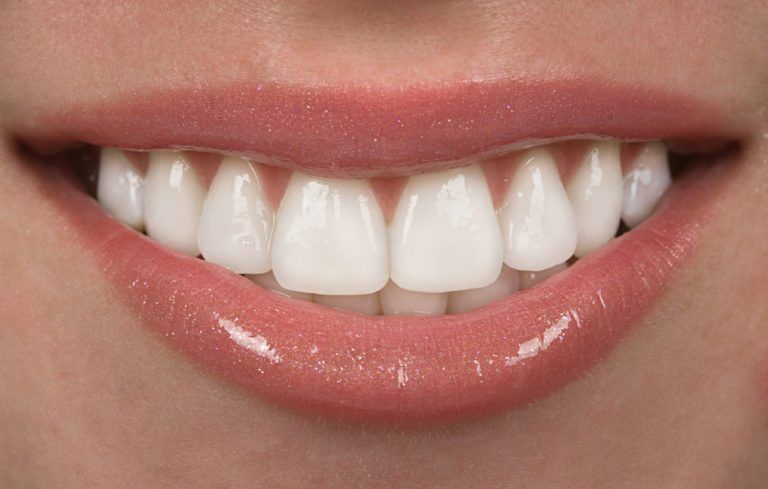 Porcelain Dental Crown and Porcelain Veneers