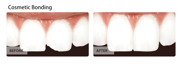 Cosmetic Bonding Before and After Images 04