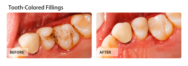 Tooth-Colored Fillings Before and After Images 04