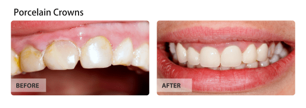Porcelain Veneers Before and After Images 01