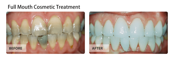 Full Mouth Cosmetic Treatment Before and After Images 01