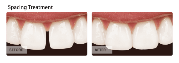 Spacing Treatment Before and After Images 03