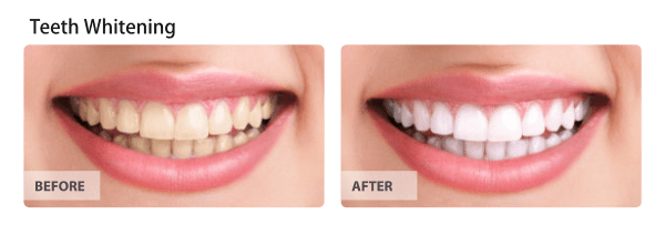 Teeth Whitening Before and After Images 03